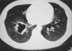 cauze pulmonare chisturi și simptome, diagnostic și tratament