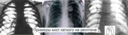 Simptomele pulmonare chisturi, tratament si remedii populare (mijloace) simptome chisturi pulmonare, tratament si remedii populare