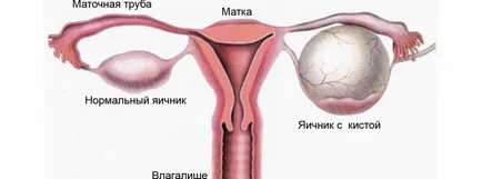 chirurgie chist ovarian, fără tratament, remedii populare și droguri