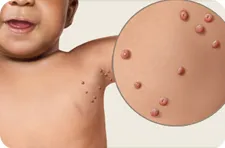 Molluscum contagiosum la copii - portalul medical EUROLAB