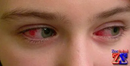 Conjunctivita este contagioasă sau nu, și ceea ce el este periculos