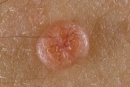 căi contagiosum de infecție, metode de îndepărtare