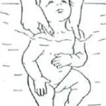 Torticolis la sugari simptome, cauze, tratament, masaj, gimnastică