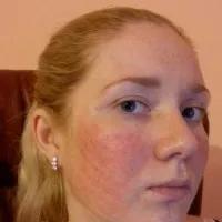 contraindicatii părului cu laser de îndepărtare, și consecințe asupra sănătății, vătămare și secundare (foto și
