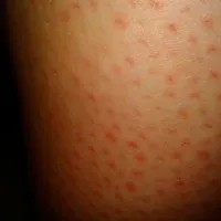 contraindicatii părului cu laser de îndepărtare, și consecințe asupra sănătății, vătămare și secundare (foto și