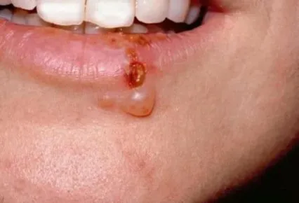 herpesul labial este ceea ce este, de tratament, fotografii