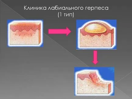 Labială herpes cura, ceea ce este și o fotografie (tratament) Labială herpes cura, ceea ce este și fotografii