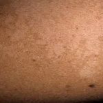 Tratamentul licheni colorate - creme și remedii populare