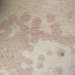 Tratamentul licheni colorate - creme și remedii populare