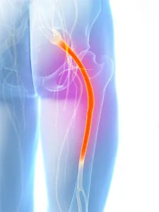 Tratamentul pentru remedii sciatica populare la domiciliu, simptome si tratament al nervului sciatic
