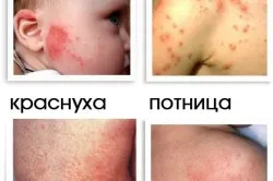 Tratamentul de alergie pe fața diferențelor nou-născut, erupții cutanate, varietate (video) (tratament) Tratamentul de alergie pe fața diferențelor nou-născut, erupții cutanate, soi (video)