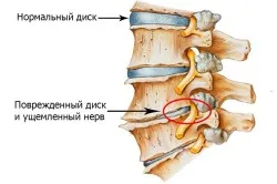 chondrosis Acasă Tratamentul