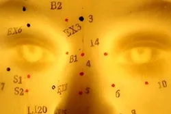 acupunctura tratament, acupunctura