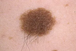 remedii populare Melanomul Tratamentul