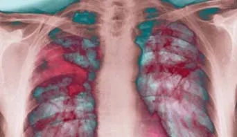 Tratamentul de remedii populare fibroză pulmonară