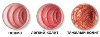 Tratamentul colitei intestinale de atac folk