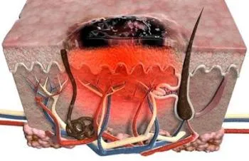 remedii populare Melanomul Tratamentul