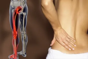 Tratamentul pentru remedii sciatica populare