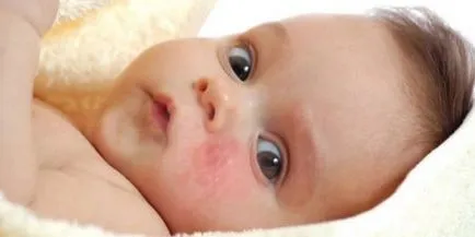 Tratamentul dermatitei atopice la copii remedii populare (26 poze) (copii) Tratamentul dermatitei atopice la copii remedii populare (26 poze)