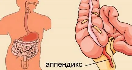 Tratamentul apendicitei fără remedii Preparate chirurgicale populare (operațiuni) tratament apendicita fara preparate chirurgie remedii populare