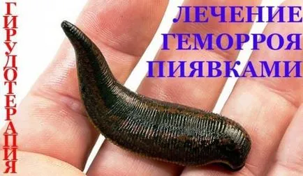 Tratamentul hemoroizilor cu lipitori - eficiență Miză unitară și comentarii