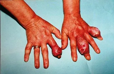 Tratamentul de guta, preparate de acid uric deducând