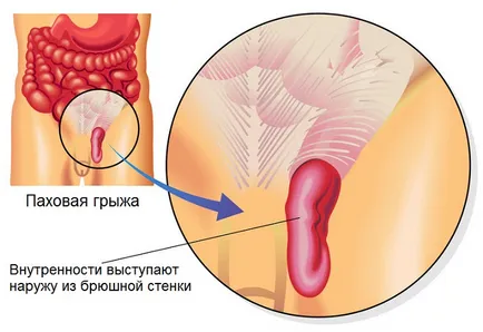 Tratamentul inghinala hernie fără operație unguent terapeutic (operații) Tratamentul inghinala hernie fără operație unguent curativ