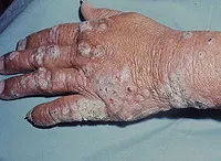 Lepră - cauze, simptome, diagnostic și tratament
