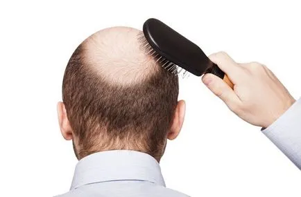 chelia la coroana în cauzele și tratamentul masculin (bărbați) chelia pe coroana la barbati cauze si tratament