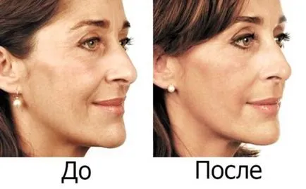 Cele mai bune rețete de acasă măști „Dimexidum“ fata (poate) Cele mai bune Retete masti „Dimexidum“ Face