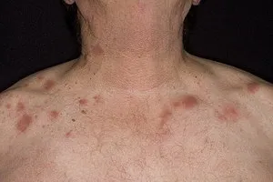 eczeme microbiana pe mâini și picioare de tratament, cauze, unguent