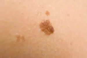 melanomul tegumentar foto și stadiul inițial, prognosticul