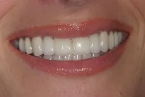 Metalo-ceramice sau zirconiu coroane pe un dinte care alege