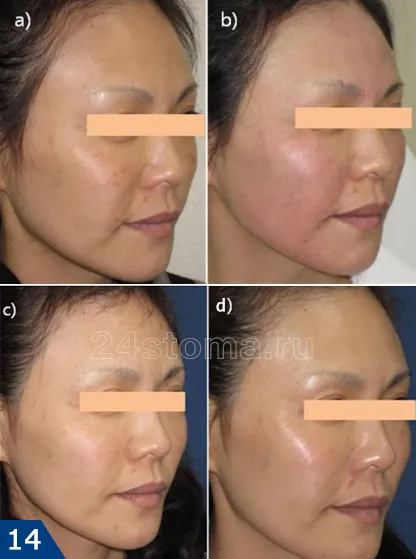 Mezoniti - comentarii, fotografii înainte și după face-lift, efectele negative (răspunsuri) Mezoniti - comentarii, fotografii înainte și după face-lift, efectele negative