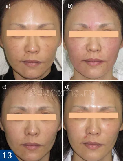 Mezoniti - comentarii, fotografii înainte și după face-lift, efectele negative (după) Mezoniti - comentarii, fotografii înainte și după face-lift, efectele negative