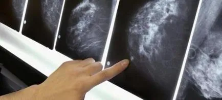 Microcalcifications in san - ceea ce este