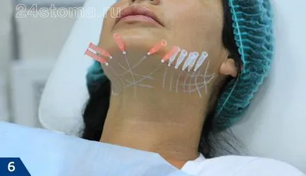Mezoniti - comentarii, fotografii înainte și după face-lift, efectele negative (răspunsuri) Mezoniti - comentarii, fotografii înainte și după face-lift, efectele negative