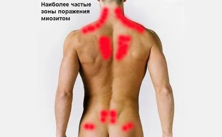 Mialgii - simptome, tratament, prevenirea bolilor