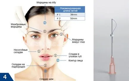 Mezoniti - comentarii, fotografii înainte și după face-lift, efectele negative (răspunsuri) Mezoniti - comentarii, fotografii înainte și după face-lift, efectele negative