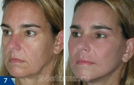 Mezoniti - comentarii, fotografii înainte și după face-lift, efectele negative (mezoniti) Mezoniti - comentarii, fotografii înainte și după face-lift, efectele negative