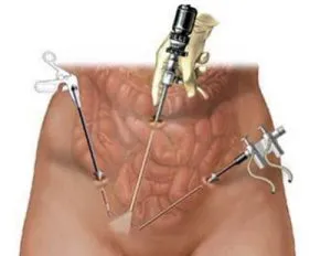 fibrom de col uterin ce este, simptomele și tratamentul de remedii populare