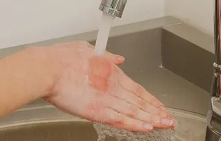 remedii populare pentru arsuri ale pielii (arsuri) remedii populare pentru arsuri ale pielii