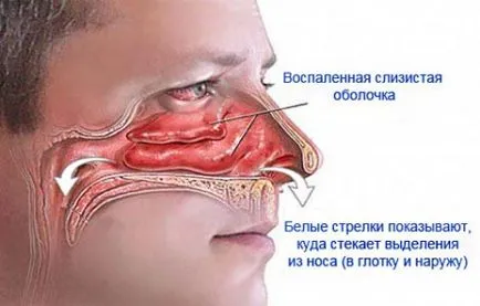 Rinoree - tratamentul răcelii comune la adulți și copii, medicina tradițională (răceala obișnuită) Rinoree - tratamentul răcelii comune la adulți și copii, medicina tradițională