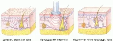 corp Rf de ridicare ce este și modul de a face pielea suplă și încordate