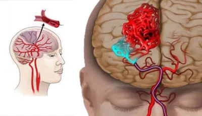 incontinenta urinara in cauzele si tratamentul masculin (incontinenta) incontinenta urinara la barbati cauze si tratament