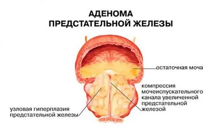 Incontinența urinară la bărbați cauze și tratament (urină) incontinenta urinara la barbati cauze si tratament