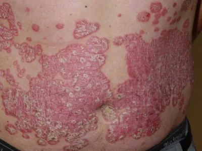 Dermatită atopică simptome și tratament (dermatita atopica provoacă simptome mâncărimi de tratament alergii cutanate de tulburări nevrotice) Dermatită atopică simptome și tratament