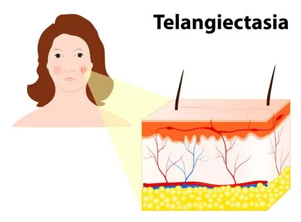 Ce telangiectazie