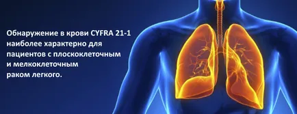 Markerii tumorali pulmonare, un marker tumoral pulmonare show oncologie