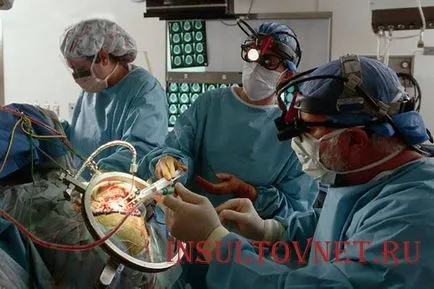 Chirurgia pentru efectele atacului cerebral și de recuperare